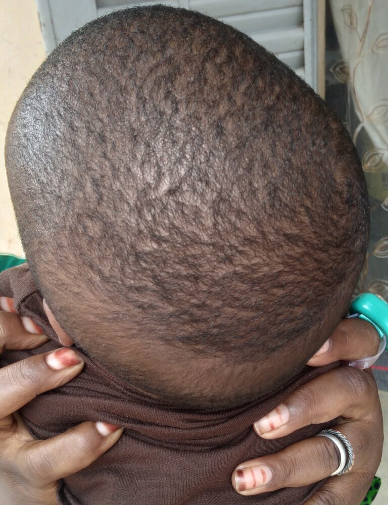 S.O.S : Pierre Dacko, un enfant de 5 mois souffrant de la maladie de  » MACROCEPHALIE » a urgemment besoin d’aide